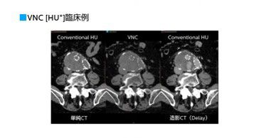 その２：VNC、Iodine No Water、ZEffective、Iodine Densityについて