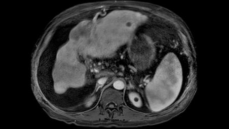 Free breathing, multi-phase liver studies