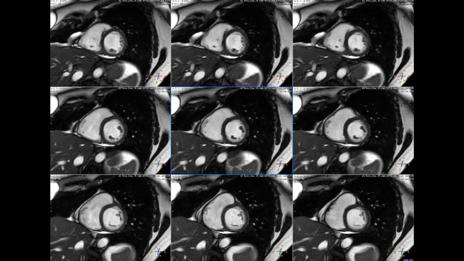 Short breathhold cardiac cine