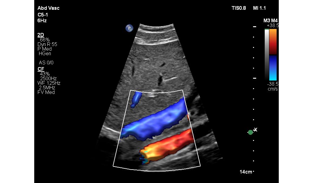 C5-1 Abd Vasc Affiniti 14 IVC Color