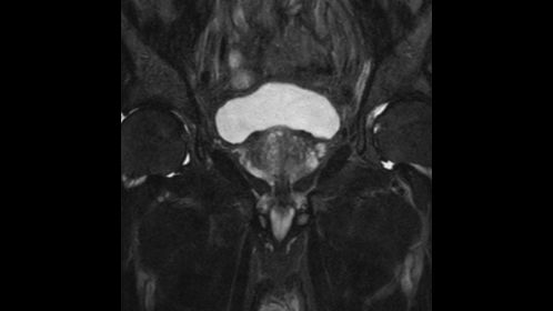 T2w SPAIR