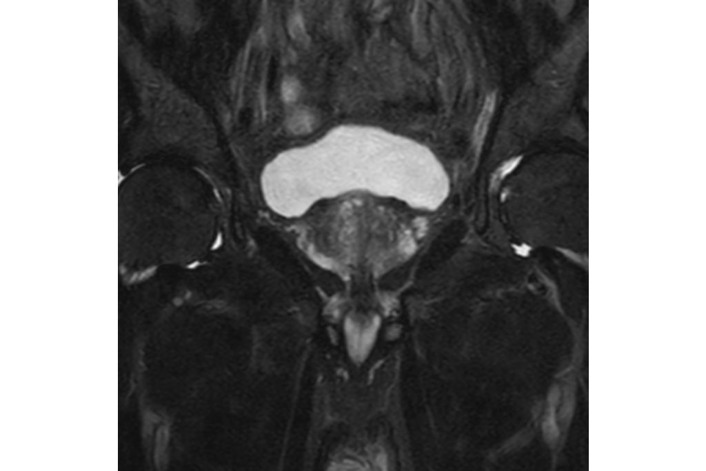 T2w SPAIR