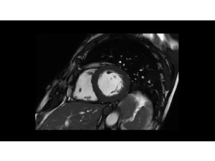SmartSpeed Precise - Cardiac MR Clinical Applications