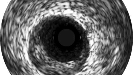 Grayscale enhances angiography procedures by enabling detailed views.
