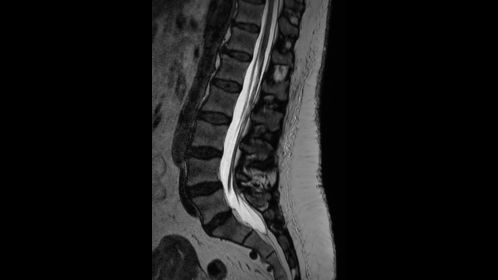 3D SpineVIEW T2w TSE