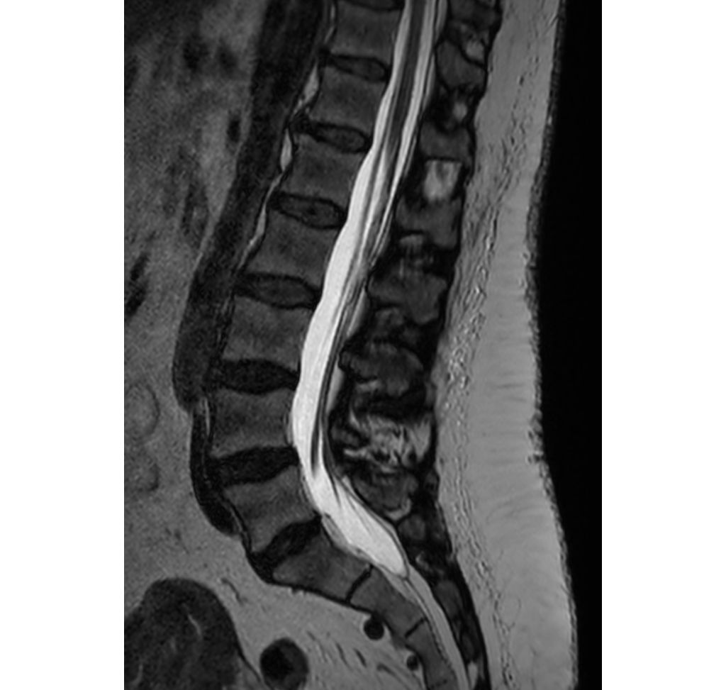 3D SpineVIEW T2w TSE
