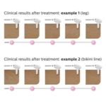 Gentle, long-term hair reduction