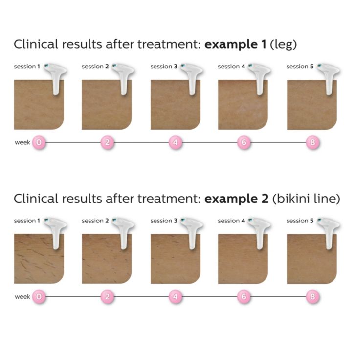 Gentle, long-term hair reduction