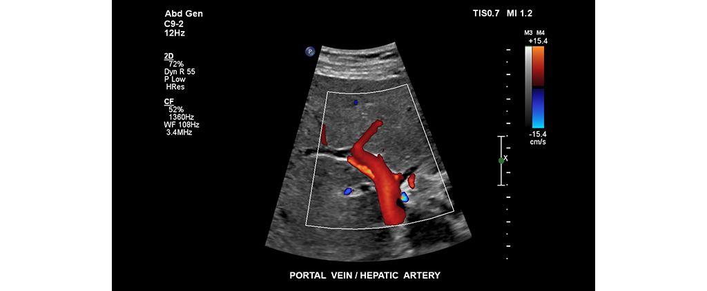 Portal vein / hepatic artery