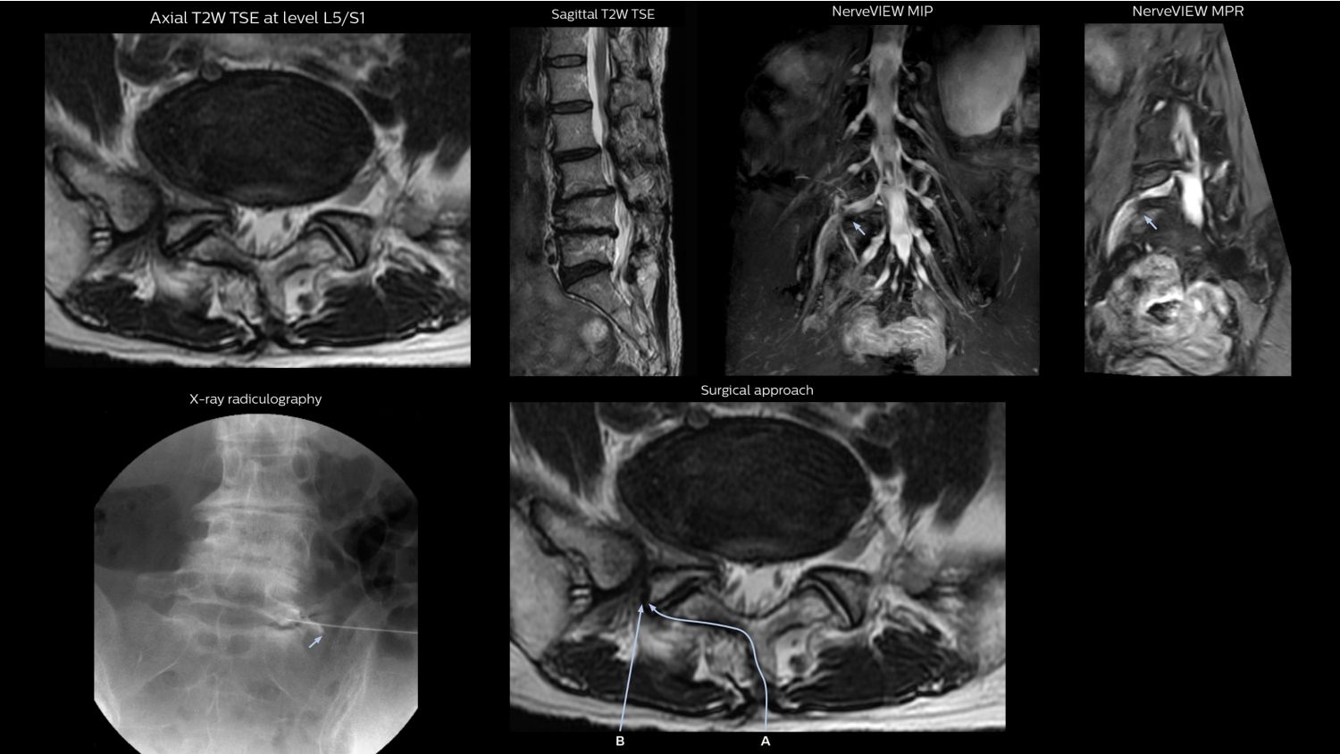 NerveVIEW shows right L5 radiculopathy and informs surgery