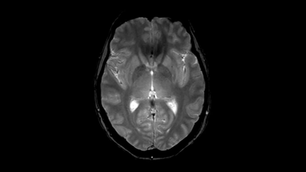T2* FFE clinical image of the brain