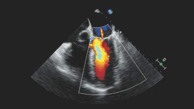 Cardiac transesophageal with mitral regurgitation