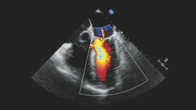 Echokardiografia przezprzełykowa ukazująca niedomykalność zastawki mitralnej
