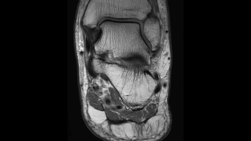 Coronal PDw TSE