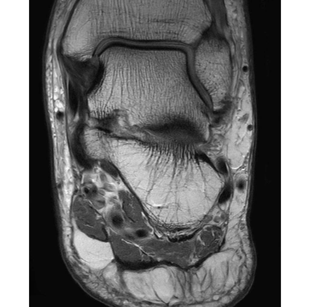 Coronal PDw TSE