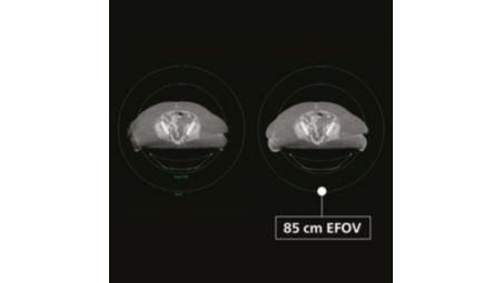 85 cm EFOV to improve treatment plan accuracy