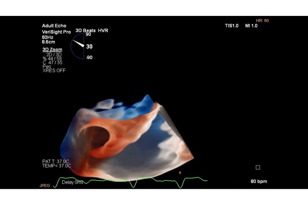 3D imaging of a left atrial appendage (LAA) from the RA with TrueVue Glass