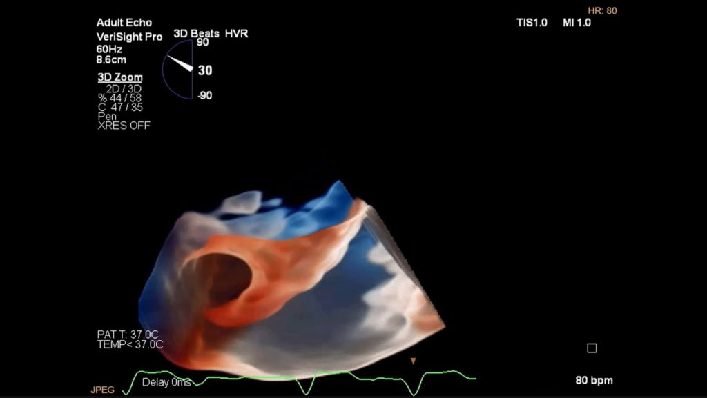 3D imaging of a left atrial appendage (LAA) from the RA with TrueVue Glass