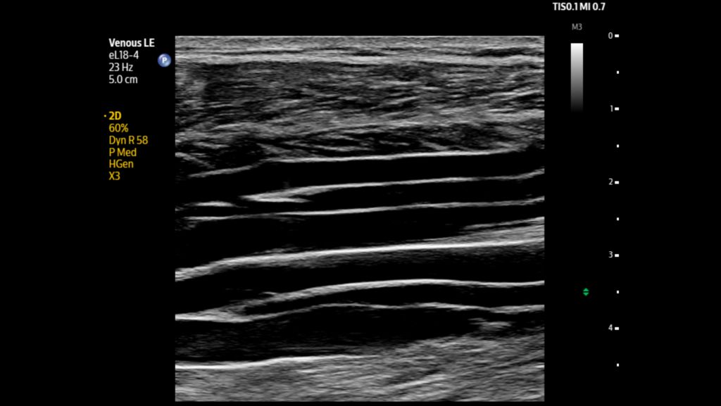 Venous posterior calf vessels shown using eL18-4 transducer.