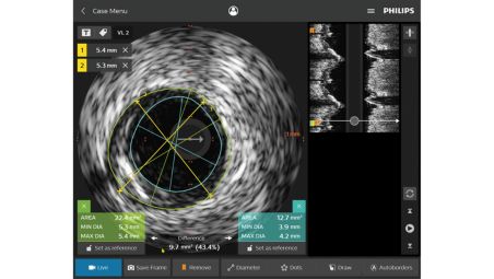 O IVUS ajuda a avaliar a doença