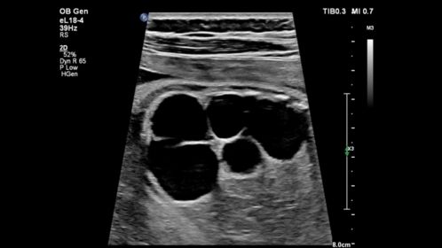 Fetal Cystic Kidneys-eL18-4