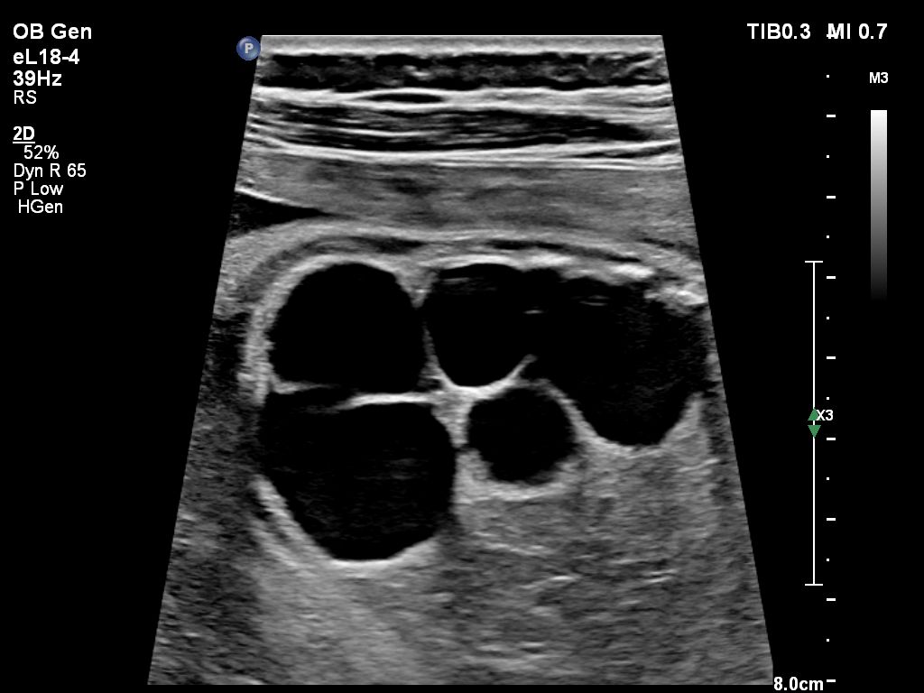 Fetal Cystic Kidneys-eL18-4