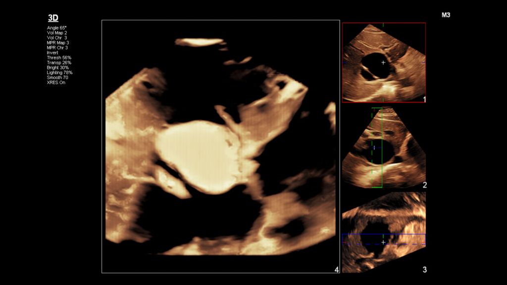X6-1 Liver Cyst