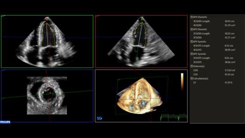 Ultrasound Workspace 3D Quantification