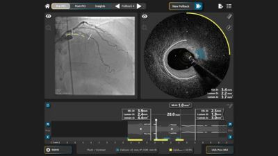 Software de imágenes intravasculares de SpectraWave que muestra angiografía coronaria y análisis de IVUS (ecografía intravascular)