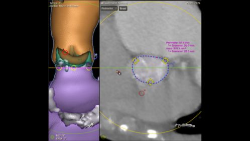 TAVI/TAVR procedure planning