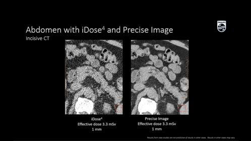 Incisive CT Precise Image pancréas