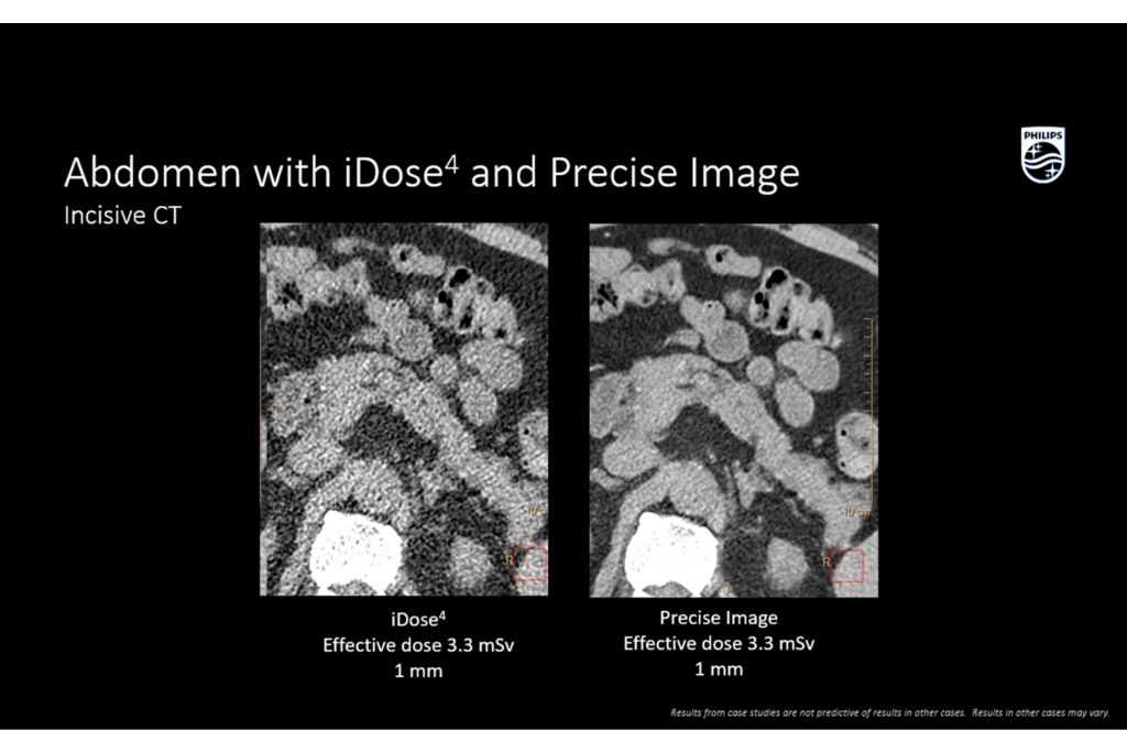 Incisive CT precise image pancreas