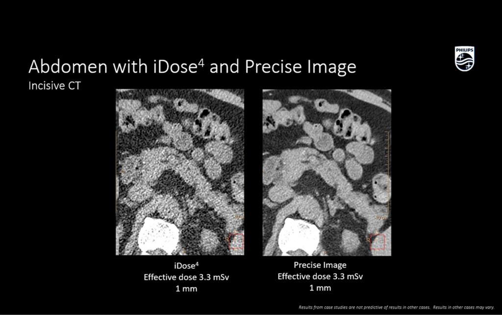 Incisive CT precise image pancreas
