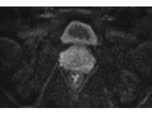 IRIS - Prostate Visualize finer structures within the body with high-quality DWI