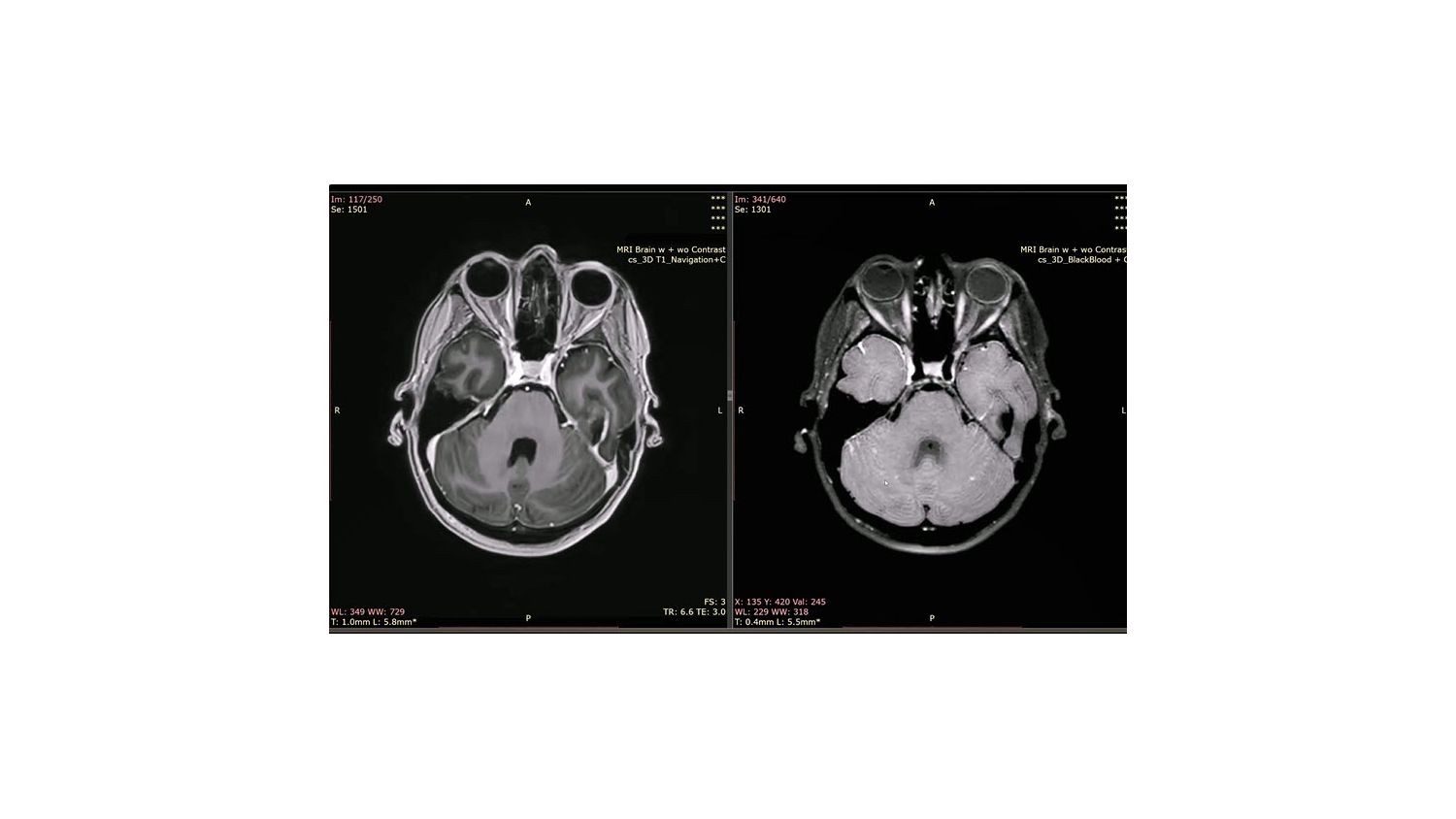 Black Blood imaging webinar