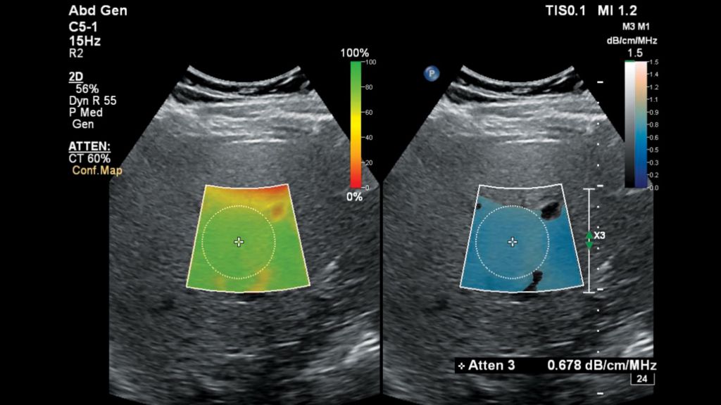 Ultrasound Web LFQ