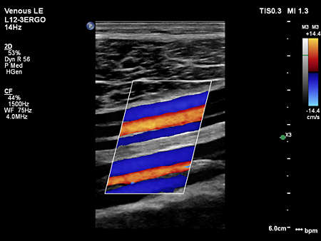 L12-3ERGO Lower Extremity Calf Vessels