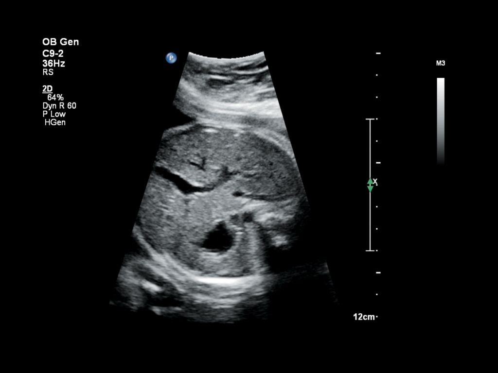 Fetal abdomen image from the Affiniti 70