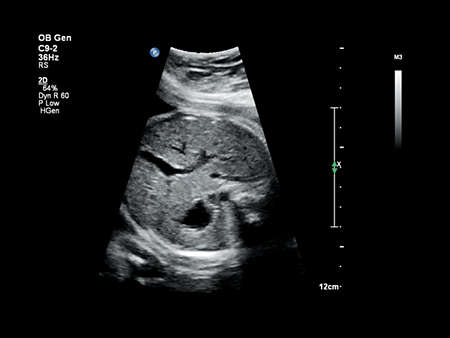 C9-2 Fetal Abdomen