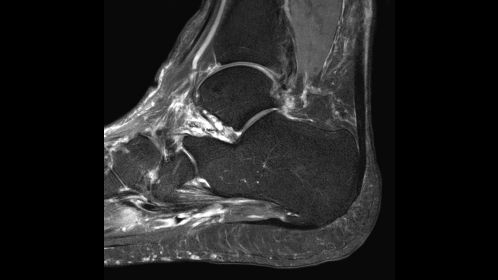 Sagittal T2w SPAIR