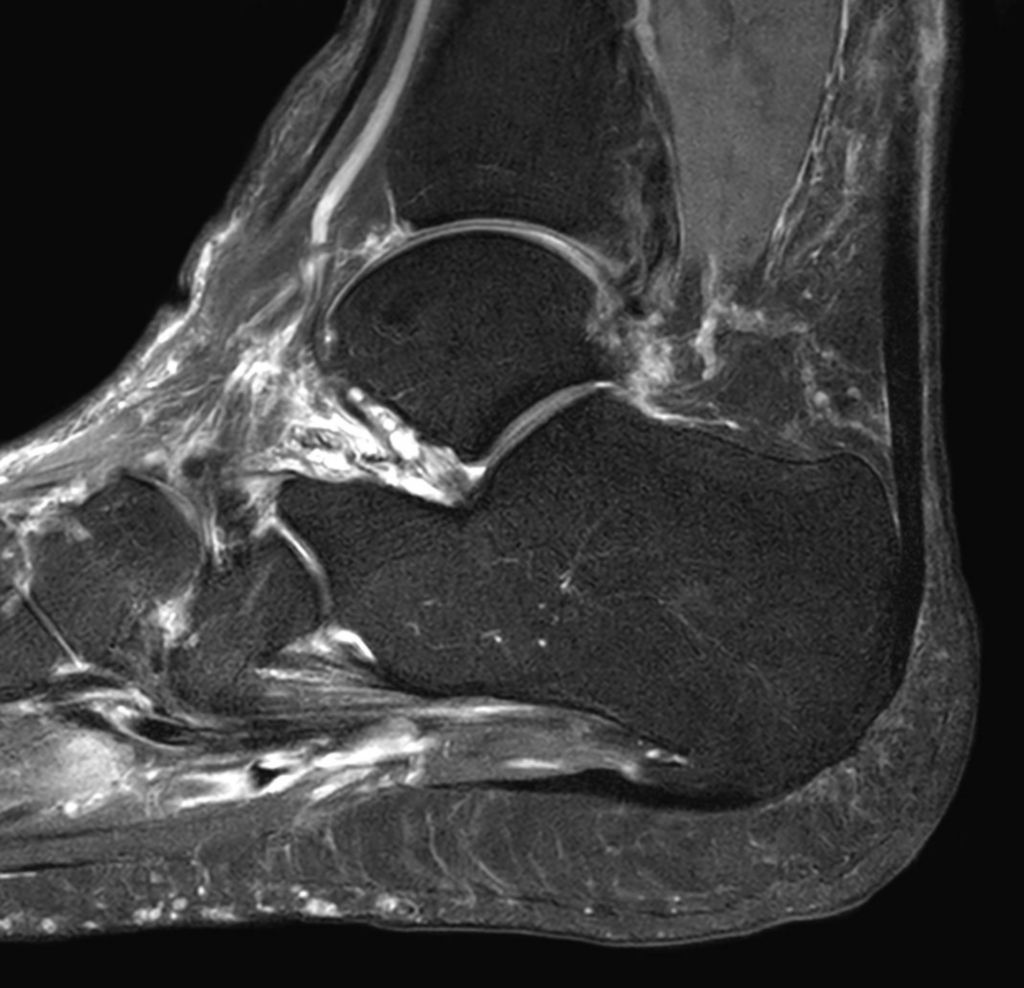 Sagittal T2w SPAIR