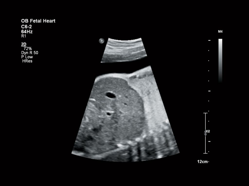 Fetal heart