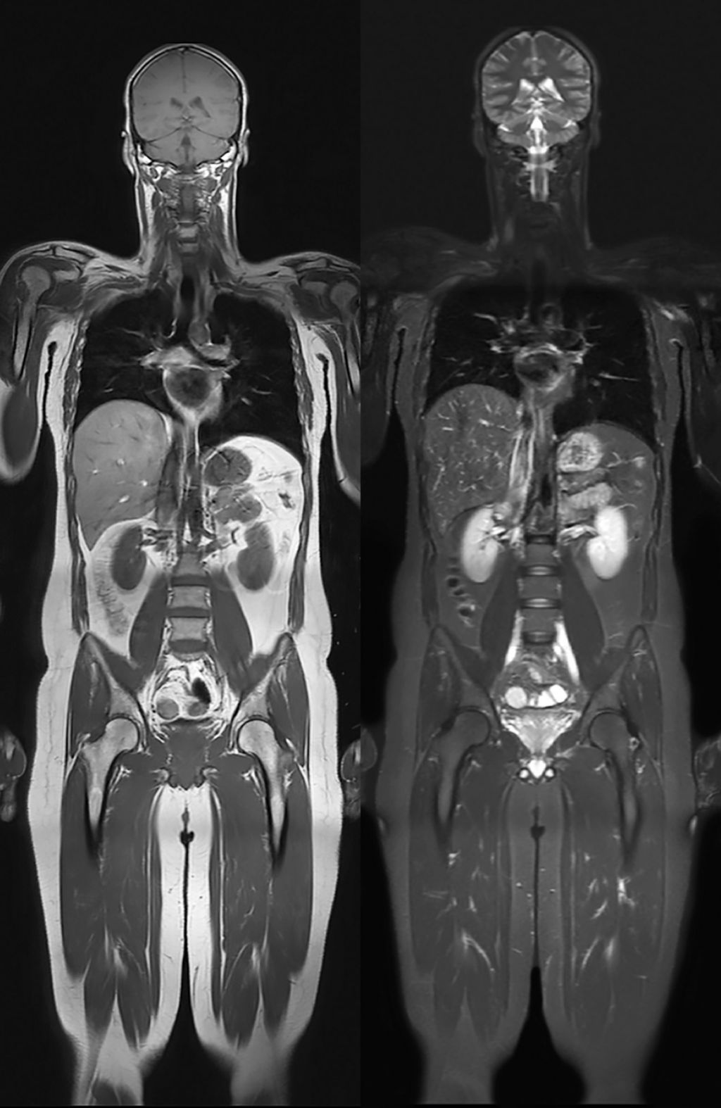 Coronal T1w TSE