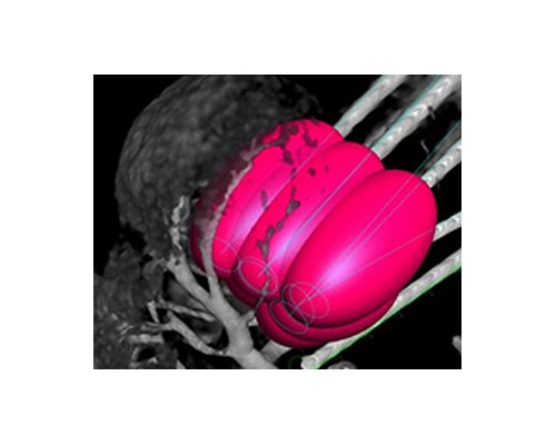 XperGuide Ablation
