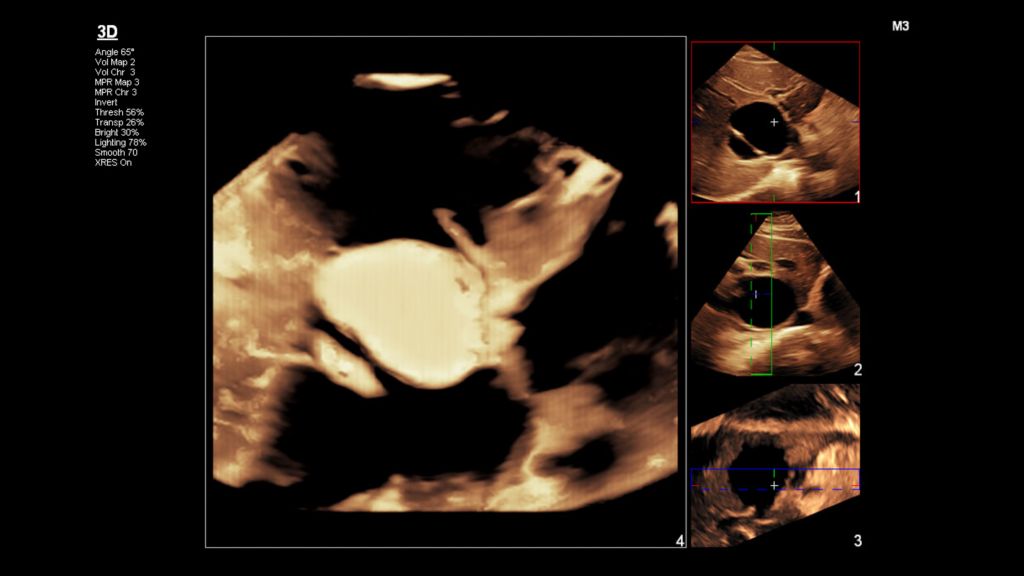 Liver cyst 3D invert