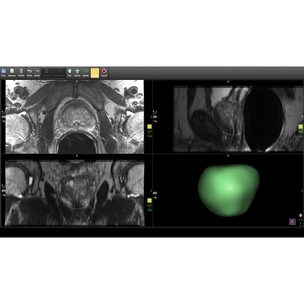 Adjustable 3D segmentations for optimally guided biopsies