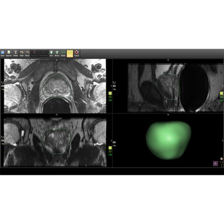 Adjustable 3D segmentations for optimally guided biopsies