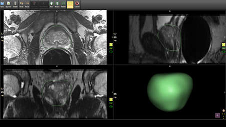 Dostosowywanie segmentacji obrazów 3D w celu optymalizacji biopsji pod kontrolą obrazu