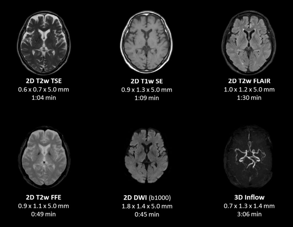 Compressed SENSE - High resolution complete brain examination in 10 minutes