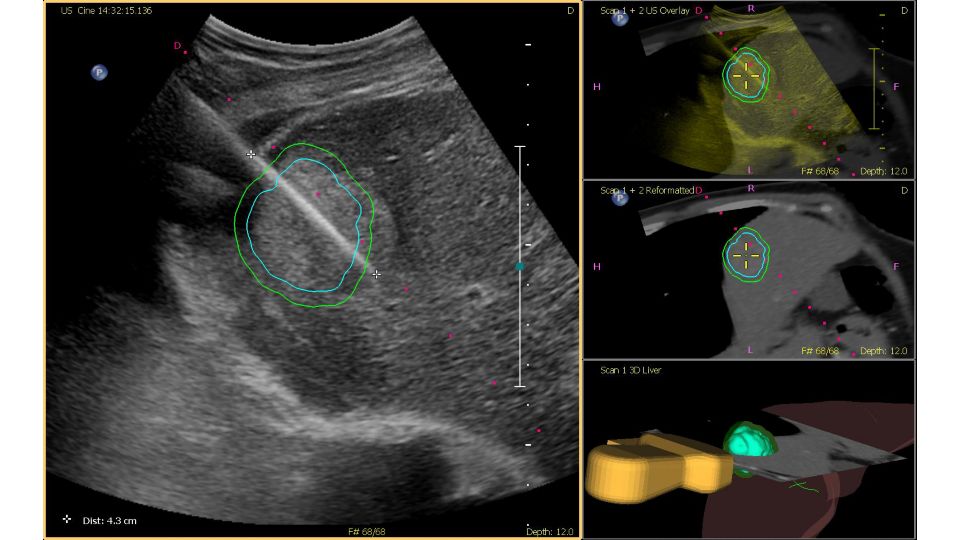 Tumor Contour Fusion Navigation